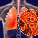 Płuca i tchawica człowieka z powiększoną wizualizacją bakterii Mycoplasma pneumoniae, które mogą wywoływać zapalenie płuc i inne objawy.