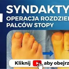 Zrośnięte palce u stóp: przyczyny, diagnostyka i leczenie