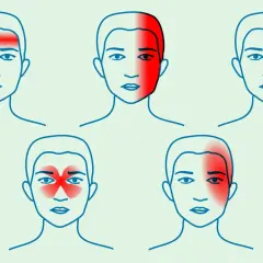 Ilustracja pokazuje różne rodzaje bólu głowy: czołowy, skroniowy, oczodołowy, zatokowy i jednostronny.