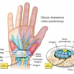 Anatomia dłoni ilustrująca cieśń nadgarstka objawy: ucisk nerwu pośrodkowego, drętwienie i ból.