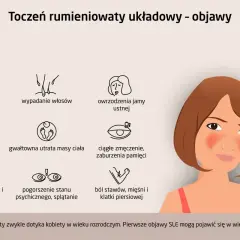 Objawy tocznia: bóle głowy, wysypka motylkowa, wypadanie włosów, owrzodzenia jamy ustnej, obrzęki, gorączka, utrata masy ciała, zmęczenie, problemy z pamięcią, bóle stawów i mięśni.