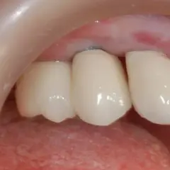 Skutki uboczne implantów z tytanu: jakie powikłania mogą cię zaskoczyć?