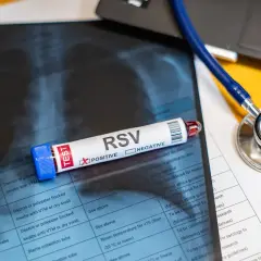 Test na wirus RSV z pozytywnym wynikiem, obok stetoskop i zdjęcie rentgenowskie klatki piersiowej.