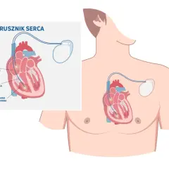 Skutki uboczne po wszczepieniu rozrusznika serca – najważniejsze informacje i objawy.