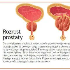 Skutki uboczne leków na prostatę: jak unikać zagrożeń i monitorować zdrowie