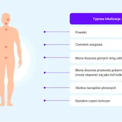 Ilustracja pokazuje typowe lokalizacje obrzęku naczynioruchowego: powieki, usta, drogi oddechowe, przewód pokarmowy, narządy płciowe i kończyny.