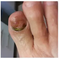 Zielona bakteria na paznokciu palca u stopy, która wygląda jak mały, zielony kamyk.