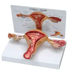 Model anatomiczny narządu rodnego z widoczną torbielą na jajniku.