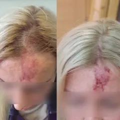 Skutki uboczne kwasu hialuronowego – co powinieneś wiedzieć przed zabiegiem?