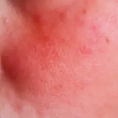 Skutki uboczne retinolu: jakie ryzyka możesz napotkać na skórze?