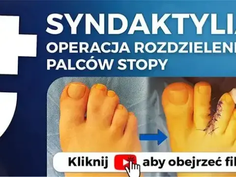 Zrośnięte palce u stóp: przyczyny, diagnostyka i leczenie