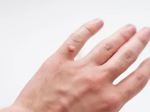 Czy kurzajki są zaraźliwe? Poznaj fakty i metody zapobiegania