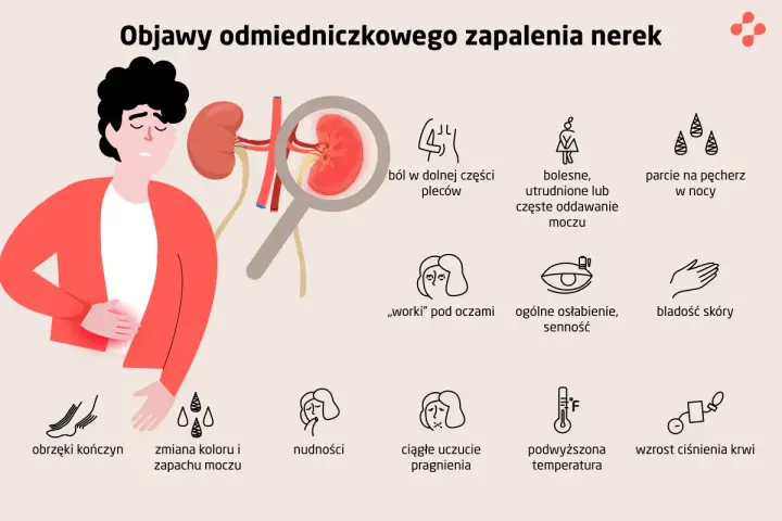 Ilustracja przedstawia objawy zapalenia nerek: ból pleców, problemy z oddawaniem moczu, obrzęki, nudności, gorączkę i inne.