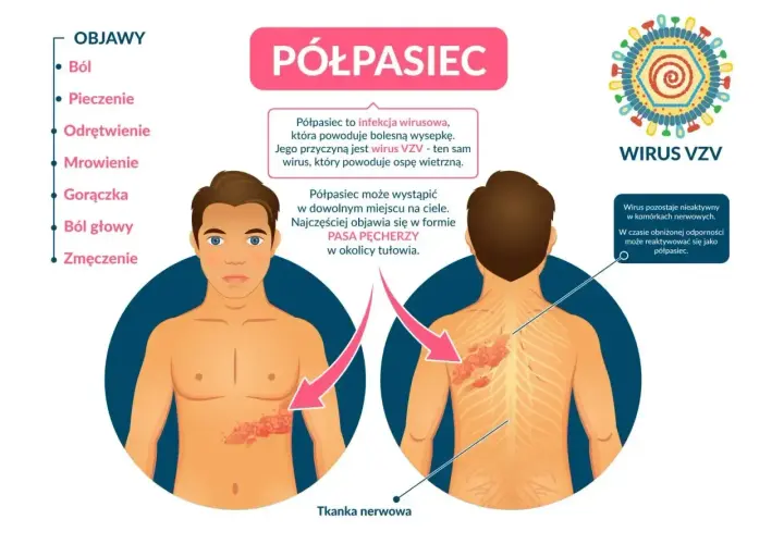 Ilustracja przedstawia objawy półpaśca, w tym ból, pieczenie i wysypkę w formie pasa pęcherzy. Nietypowe objawy półpaśca mogą obejmować również gorączkę i zmęczenie.