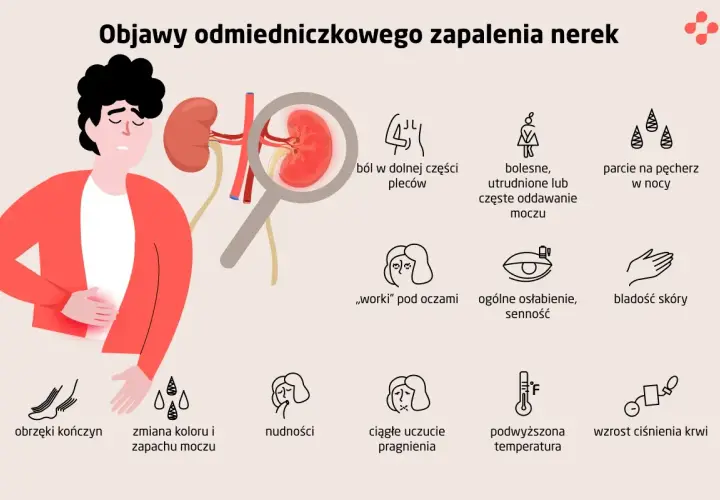 Ilustracja przedstawia objawy zapalenia nerek: ból pleców, problemy z oddawaniem moczu, obrzęki, nudności, gorączkę i inne.