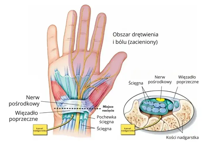 Anatomia dłoni ilustrująca cieśń nadgarstka objawy: ucisk nerwu pośrodkowego, drętwienie i ból.