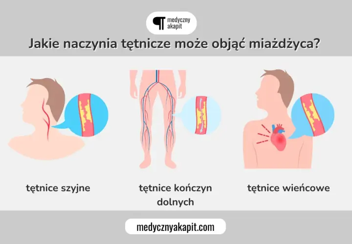 Miażdżyca objawy: zwężone tętnice szyjne, kończyn dolnych i wieńcowe. Ilustracja pokazuje, jak choroba wpływa na naczynia krwionośne.