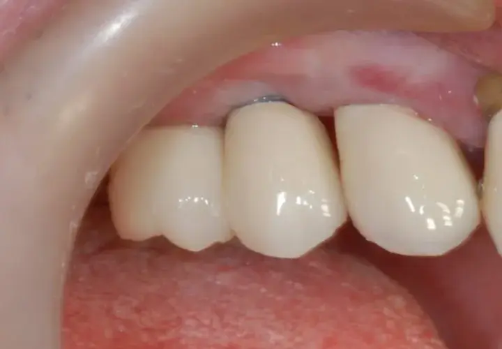 Skutki uboczne implantów z tytanu: jakie powikłania mogą cię zaskoczyć?