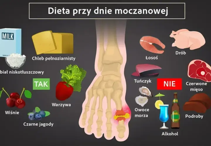 Dieta przy dnie moczanowej: TAK - nabiał, chleb, warzywa, wiśnie, jagody. NIE - drób, łosoś, tuńczyk, owoce morza, czerwone mięso, podroby, alkohol.