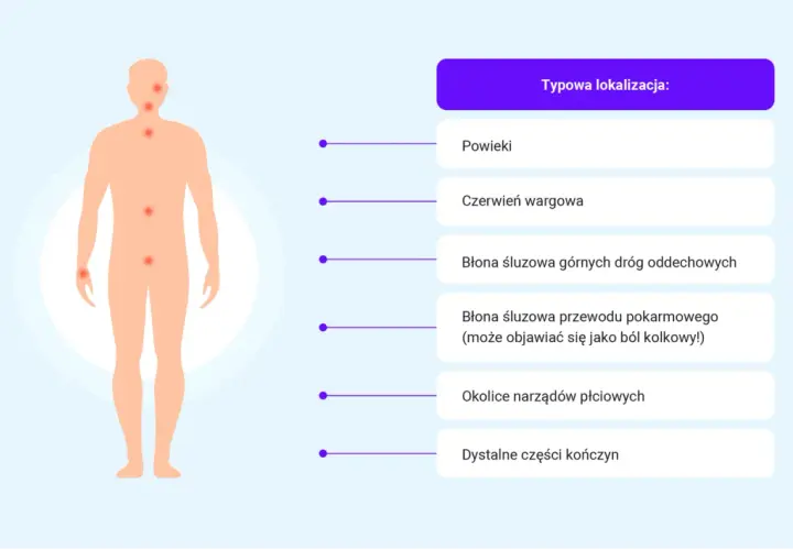 Ilustracja pokazuje typowe lokalizacje obrzęku naczynioruchowego: powieki, usta, drogi oddechowe, przewód pokarmowy, narządy płciowe i kończyny.