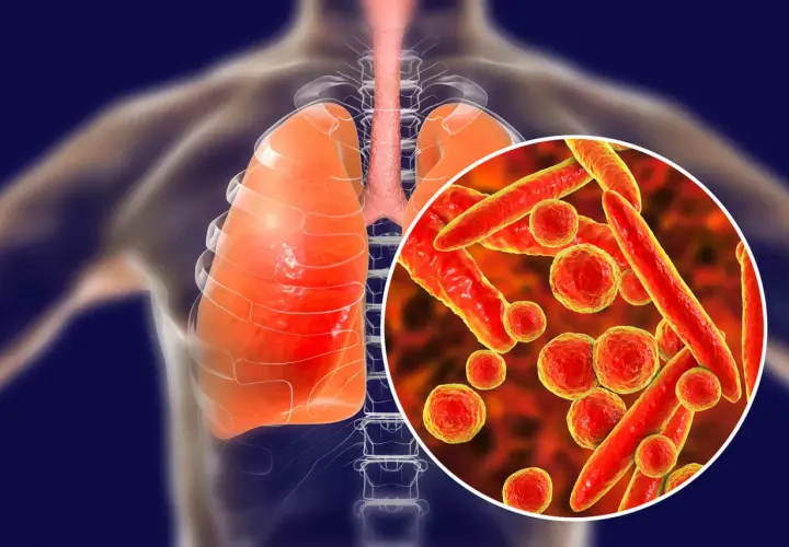 Płuca i tchawica człowieka z powiększoną wizualizacją bakterii Mycoplasma pneumoniae, które mogą wywoływać zapalenie płuc i inne objawy.