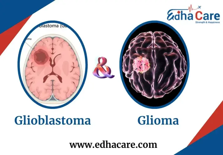 Ilustracje mózgu pokazujące guzy. Po lewej glioblastoma, po prawej glioma. Wczesne wykrycie glejaków i ich objawów jest kluczowe.