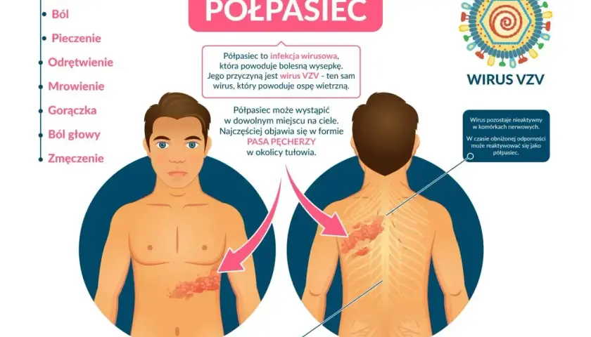 Ilustracja przedstawia objawy półpaśca, w tym ból, pieczenie i wysypkę w formie pasa pęcherzy. Nietypowe objawy półpaśca mogą obejmować również gorączkę i zmęczenie.