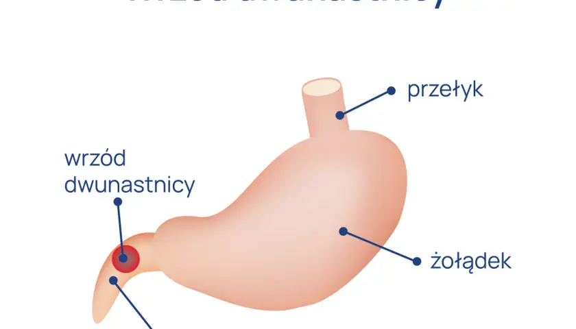 Ból dwunastnicy - objawy, które powinieneś znać. Diagnostyka