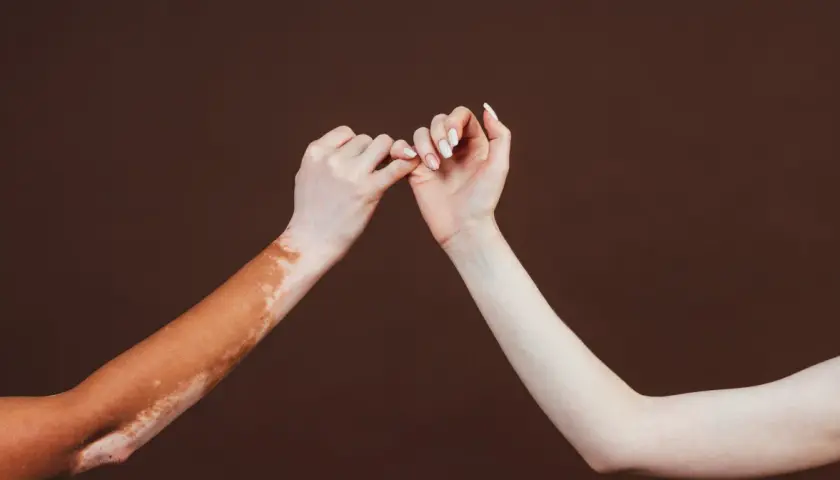 Dwie ręce splatają palce. Jedna z nich ma widoczne plamy vitiligo, symbolizujące różnorodność i akceptację.