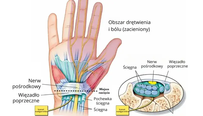 Anatomia dłoni ilustrująca cieśń nadgarstka objawy: ucisk nerwu pośrodkowego, drętwienie i ból.