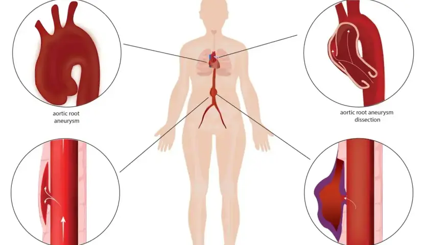 Ilustracja przedstawia powikłania naczyniowe w zespole Marfana: tętniak aorty, rozwarstwienie aorty zstępującej i pęknięcie tętniaka.