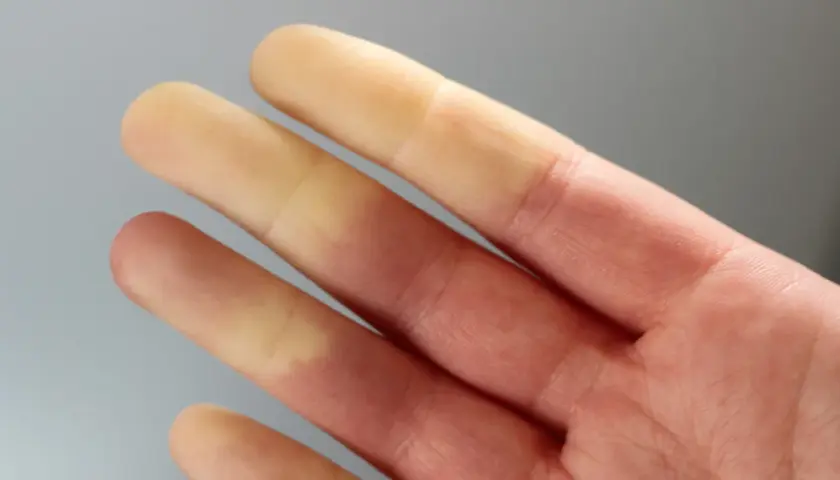 Palce dłoni z widocznymi zmianami koloru, wskazującymi na zespół Raynauda.