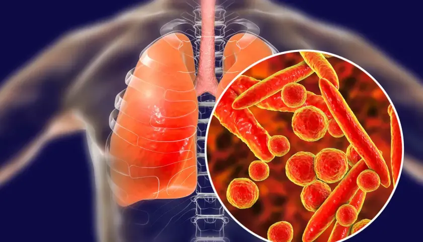 Płuca i tchawica człowieka z powiększoną wizualizacją bakterii Mycoplasma pneumoniae, które mogą wywoływać zapalenie płuc i inne objawy.