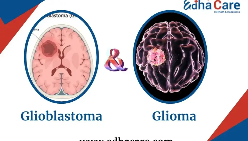 Ilustracje mózgu pokazujące guzy. Po lewej glioblastoma, po prawej glioma. Wczesne wykrycie glejaków i ich objawów jest kluczowe.