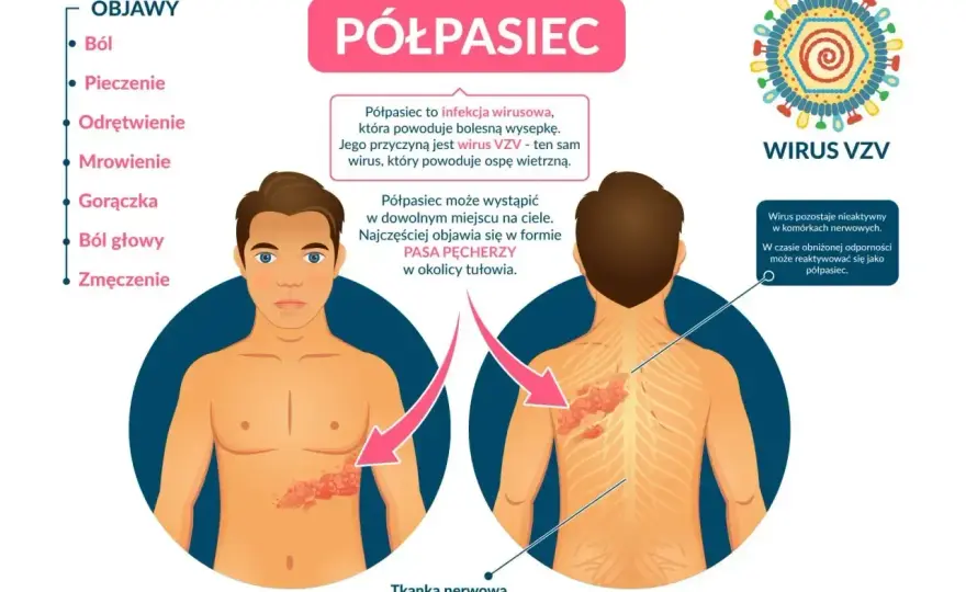 Nietypowy półpasiec - objawy, ból bez wysypki i alarmujące sygnały