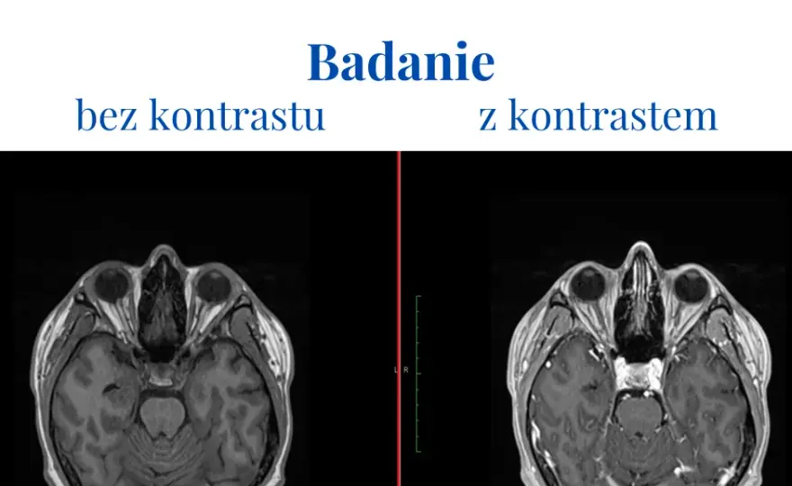 Skutki uboczne po podaniu kontrastu tomografii - co warto wiedzieć?