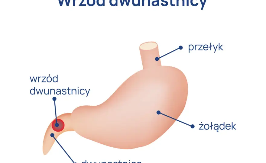 Ból dwunastnicy - objawy, które powinieneś znać. Diagnostyka