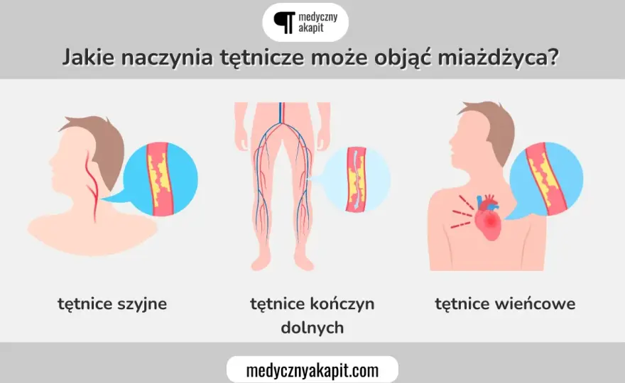 Miażdżyca - objawy: kiedy ból to sygnał alarmowy?