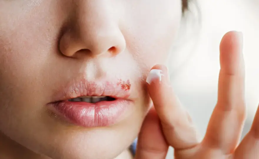 Herpes - dlaczego wraca? Objawy, leczenie i zapobieganie