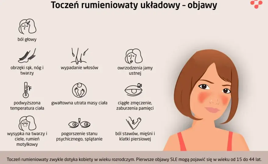 Toczeń rumieniowaty układowy - objawy, diagnoza i leczenie