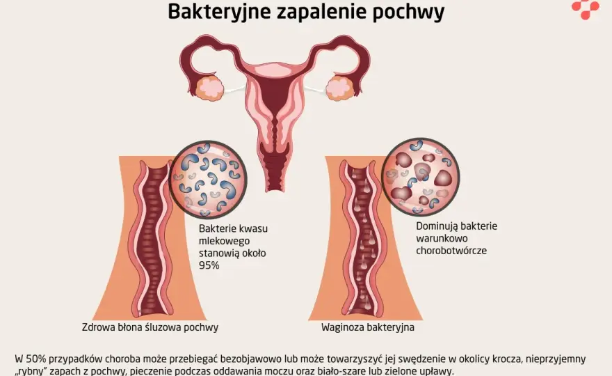Zapalenie pochwy - Bakteryjna waginoza czy grzybica?