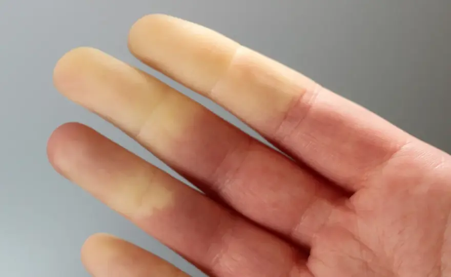Zespół Raynauda - Kiedy zimne palce to coś więcej?