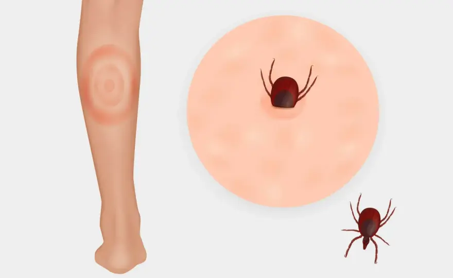 Rumień po ukąszeniu owada - Kiedy to borelioza, a kiedy alergia?