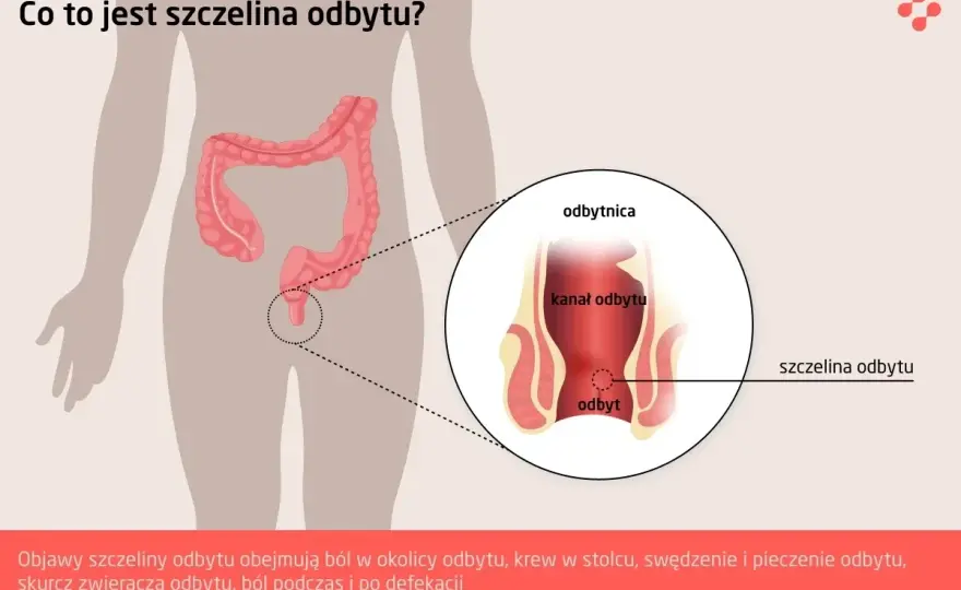 Zwieracze odbytu - objawy uszkodzenia, o których musisz wiedzieć