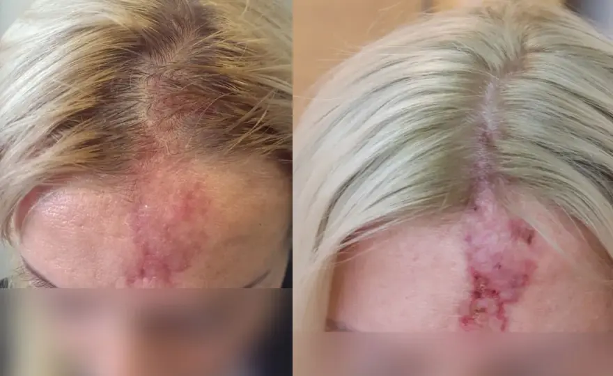 Skutki uboczne kwasu hialuronowego – co powinieneś wiedzieć przed zabiegiem?