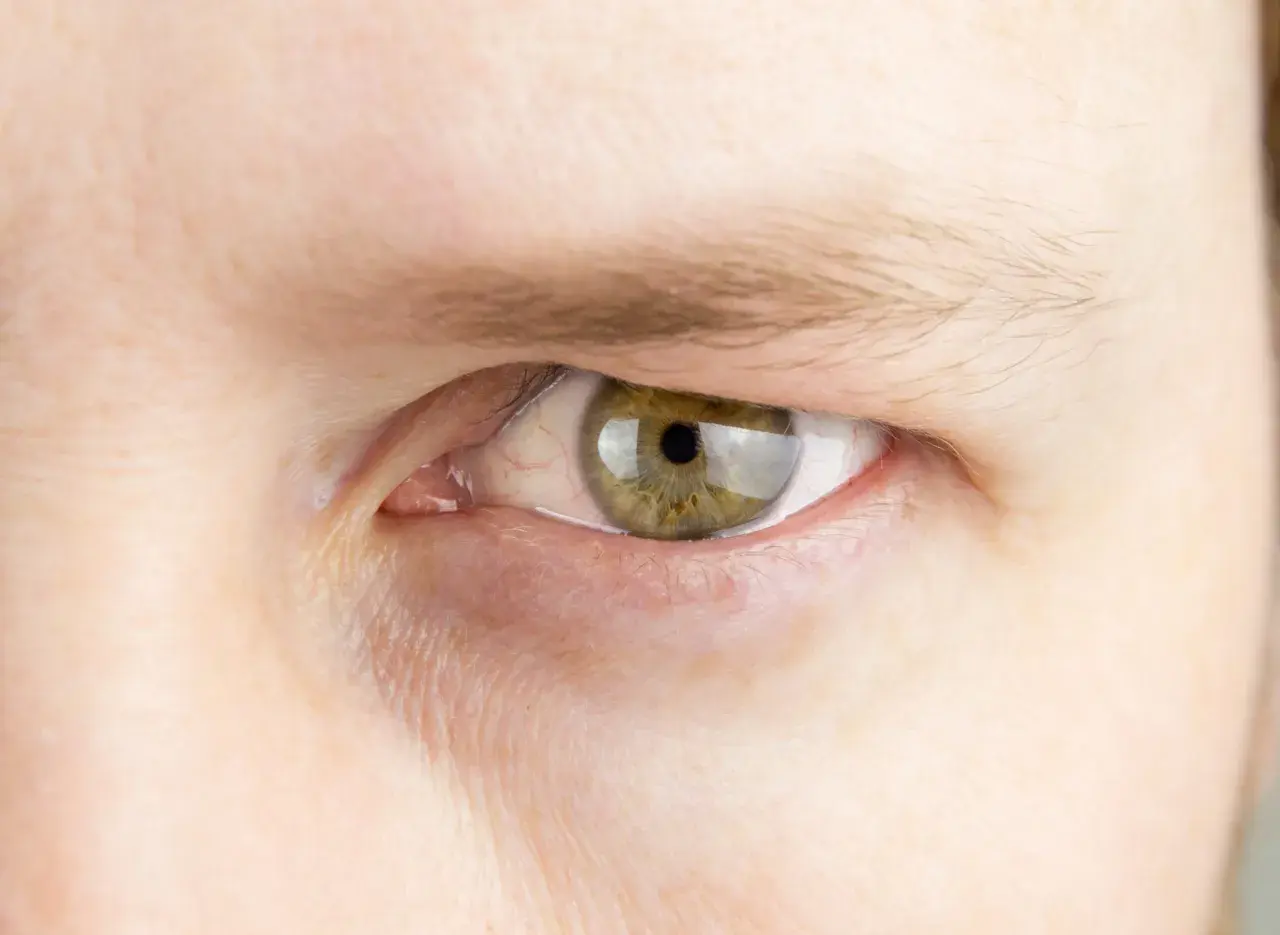 Zbliżenie na ludzkie oko z zieloną tęczówką. Widoczna jest opadająca powieka, zaczerwienione naczynka i drobne zmarszczki wokół oka.