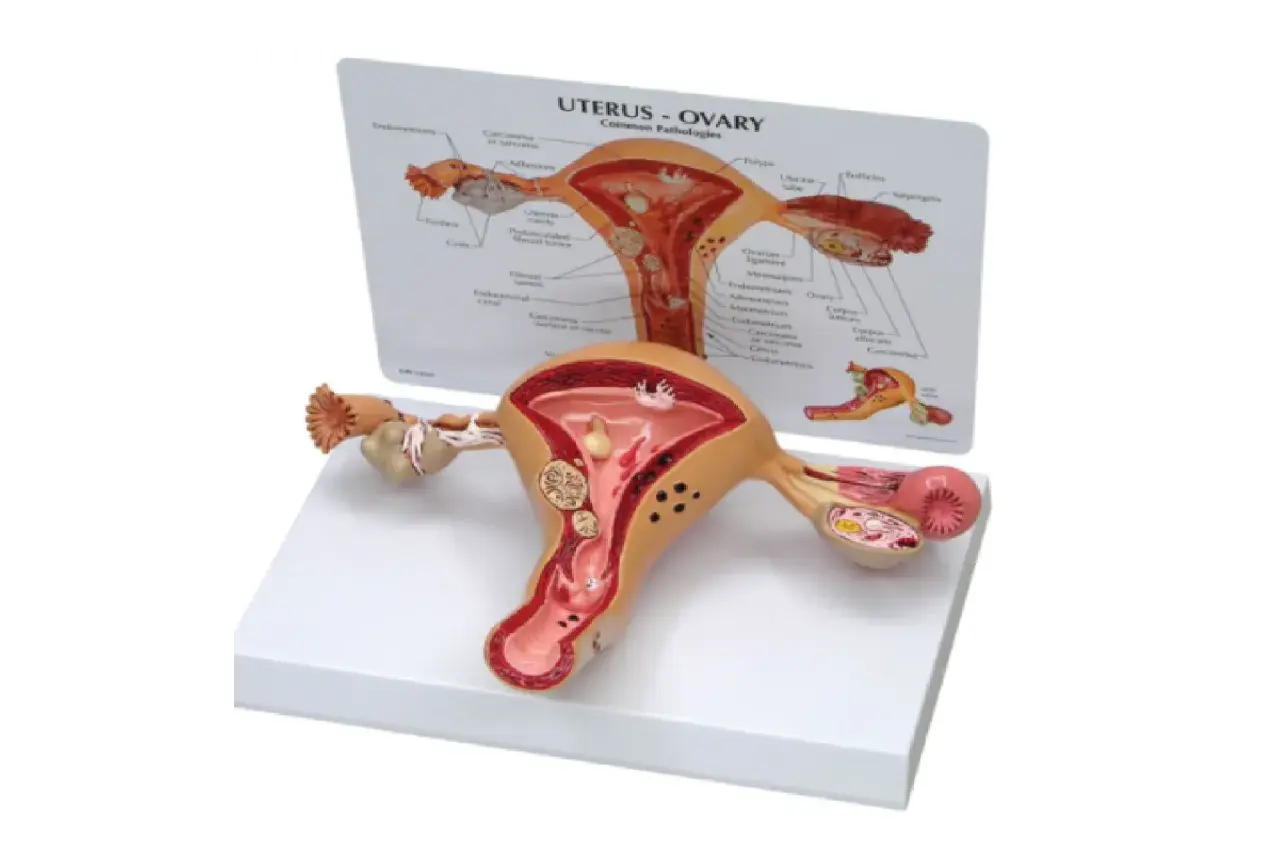 Model anatomiczny narządu rodnego z widoczną torbielą na jajniku.