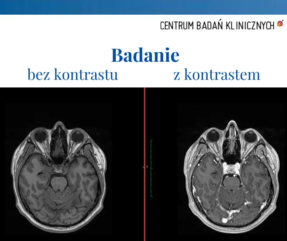 Zdjęcie Skutki uboczne tomografii komputerowej: promieniowanie, reakcje i ryzyko zdrowotne