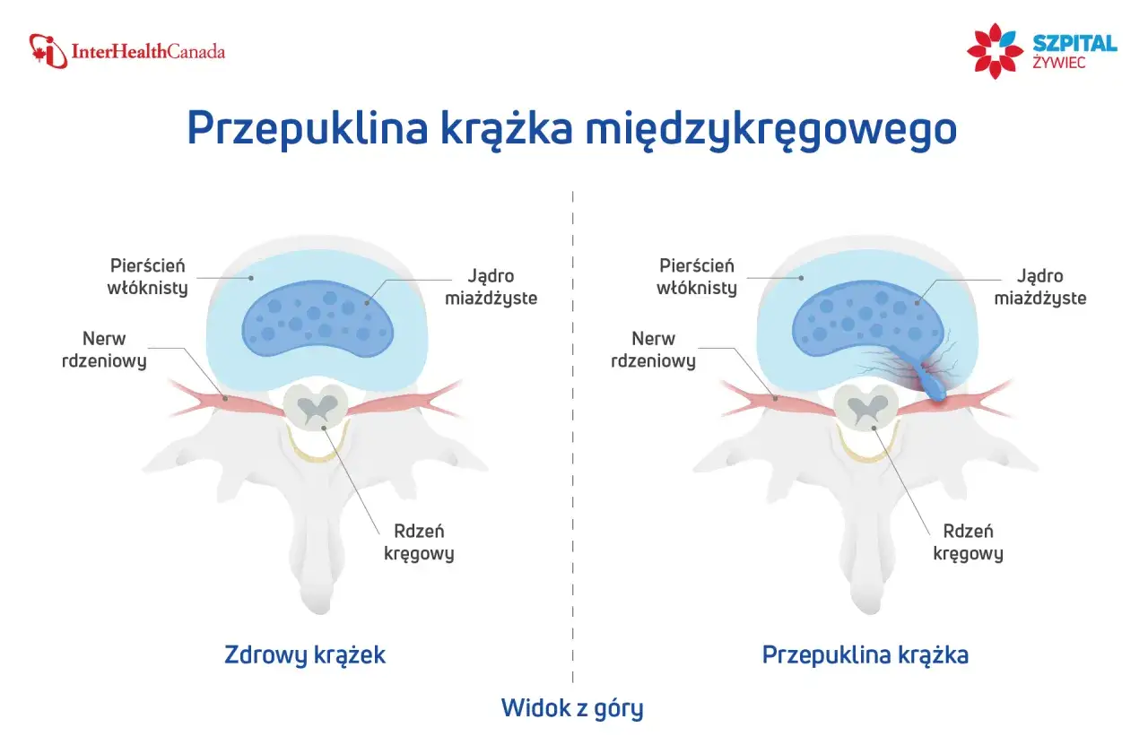 Ilustracja pokazuje zdrowy krążek międzykręgowy i przepuklinę krążka, gdzie jądro miażdżyste uciska nerw rdzeniowy.
